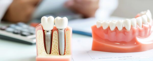 Prothèses dentaires et implants
